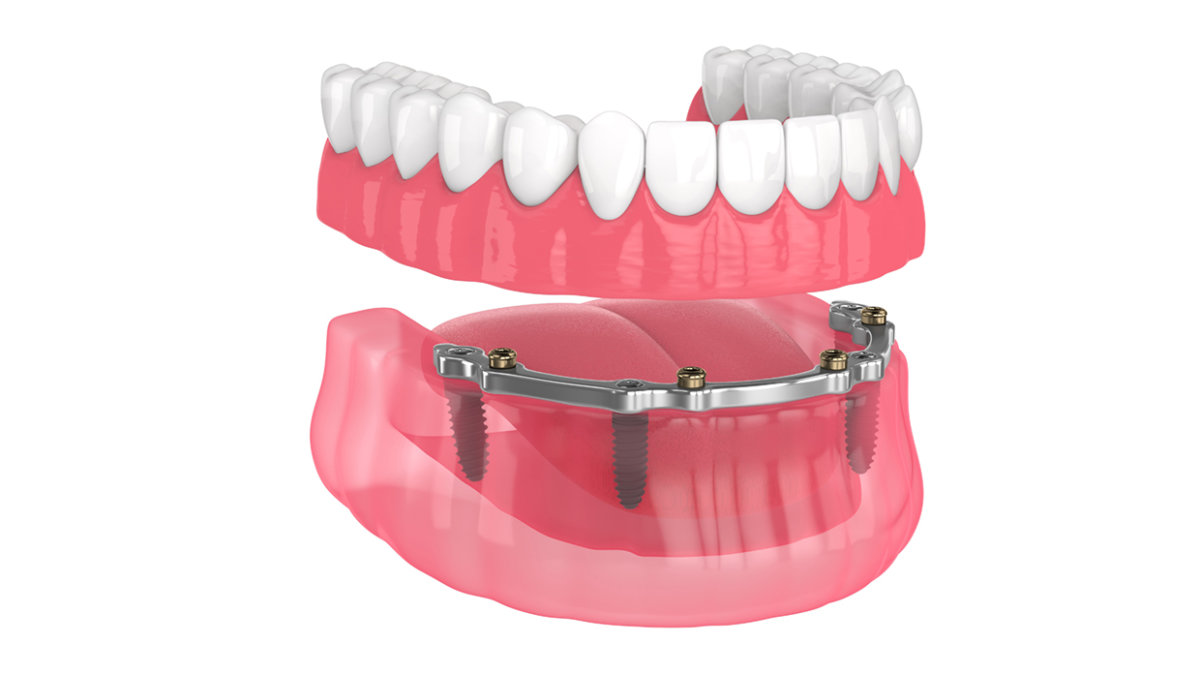 All-on-4 implant dentures illustration showing full arch tooth replacement