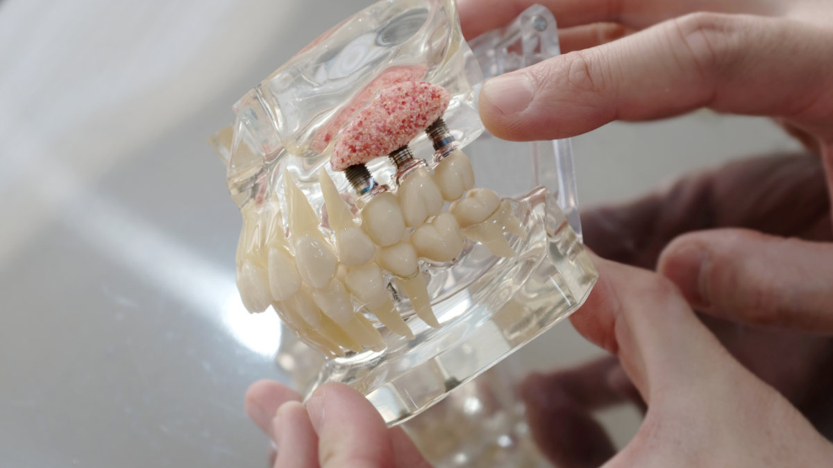 Close-up of tooth model illustrating sinus lift for dental implants
