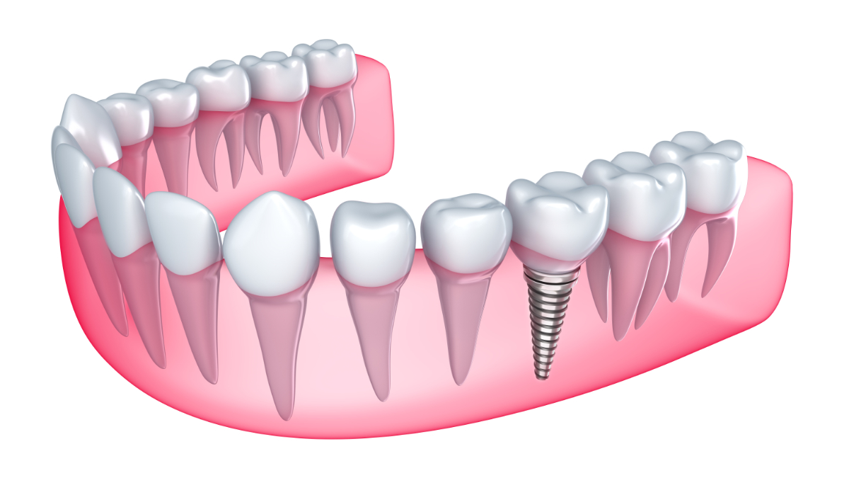 Illustration of single dental implant placed in lower jawbone